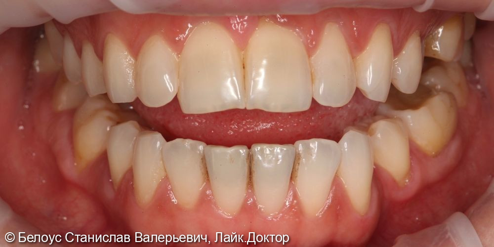 Профессиональная гигиена полости рта по швейцарскому протоколу Gbt - фото №2
