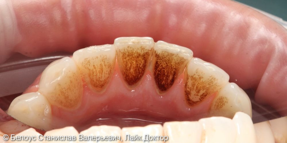 Профессиональная гигиена полости рта по швейцарскому протоколу Gbt - фото №3