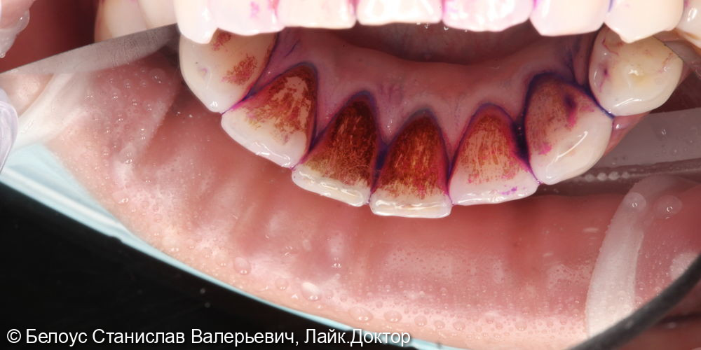 Профессиональная гигиена полости рта по швейцарскому протоколу Gbt - фото №6