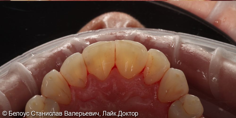 Профессиональная гигиена полости рта по швейцарскому протоколу Gbt - фото №8