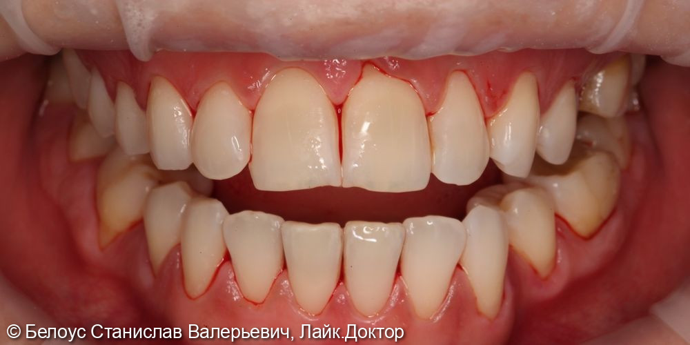 Профессиональная гигиена полости рта по швейцарскому протоколу Gbt - фото №9