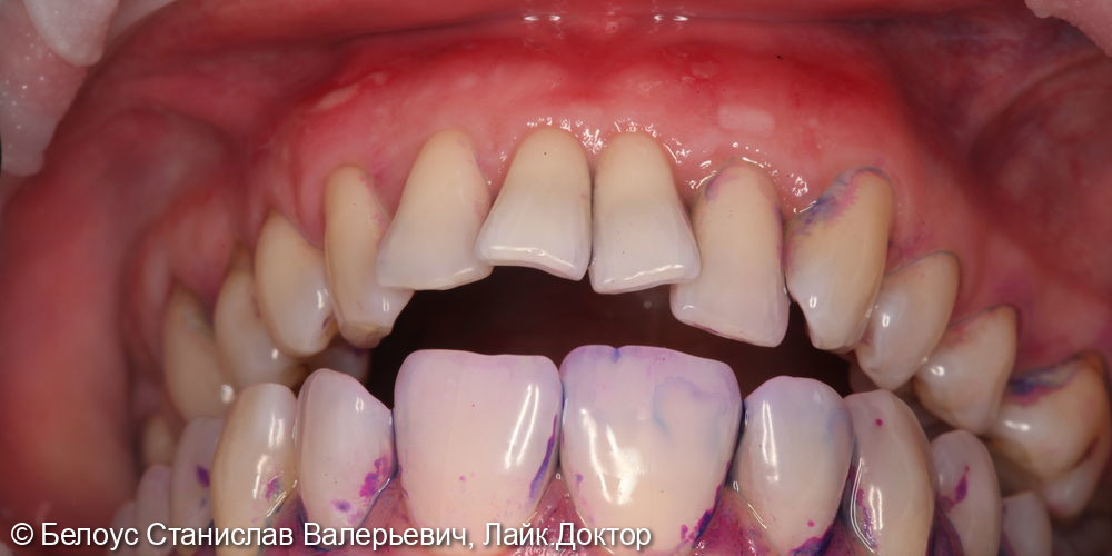 Профессиональная гигиена полости рта по протоколу GBT - фото №1