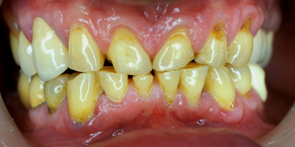 Пациент обратился с жалобами на эстетику зубов верхний и нижней челюсти - фото №1