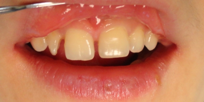 Исправление косметического дефекта передних зубов - фото №1