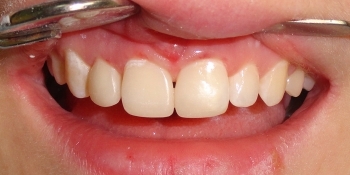 Исправление косметического дефекта передних зубов - фото №2