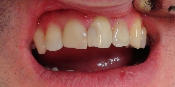 Реставрация зубов светокомпозитным материалом - фото №1