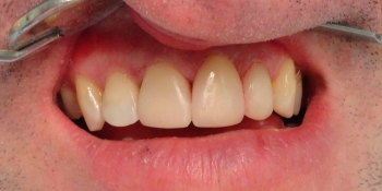 Реставрация зубов светокомпозитным материалом - фото №2