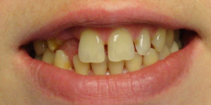 Реставрация зубов, адгезивный мост - фото №1