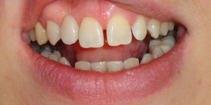 Реставрация зубов, адгезивный мост - фото №2