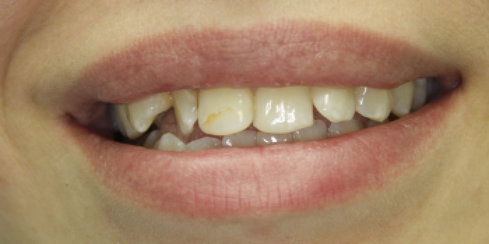 Художественная реставрация и восстановление зубов композитным материалом - фото №1