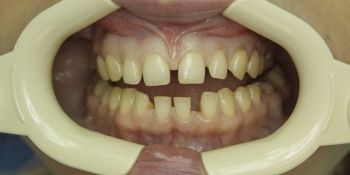 Устранение большой щели между зубами - фото №1