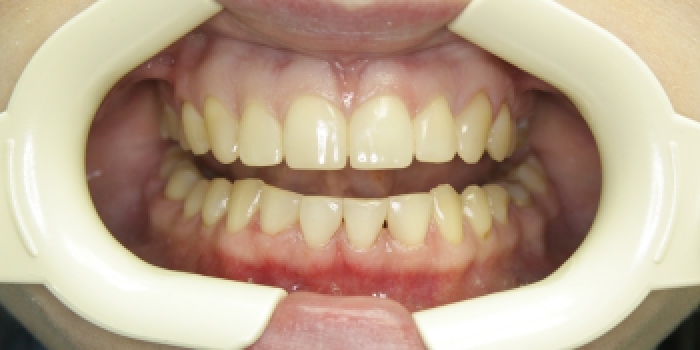 Устранение большой щели между зубами - фото №2