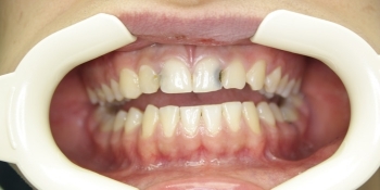 Лечение глубокого кариеса зубов, художественная реставрация - фото №1
