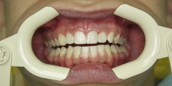 Лечение глубокого кариеса зубов, художественная реставрация - фото №2