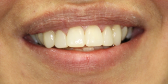 Восстановление зубов с установкой полупрямых композитных виниров Componeer - фото №2
