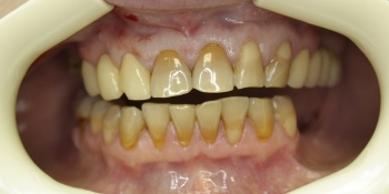 Реставрация передних зубов композитным материалом - фото №1