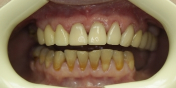 Реставрация передних зубов композитным материалом - фото №2