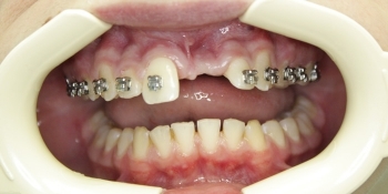 Восстановление зуба на стекловолоконной конструкции - фото №1