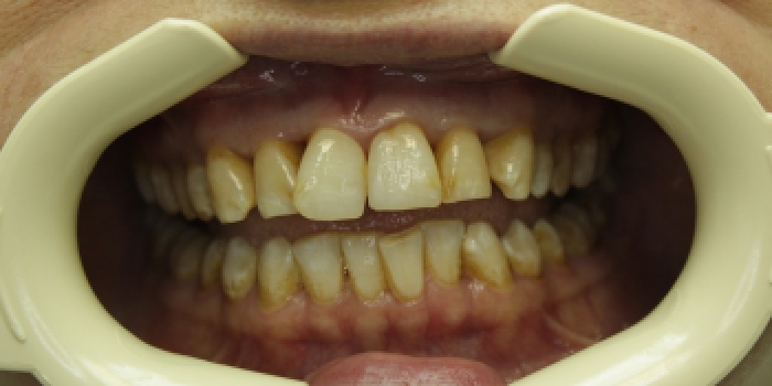 Восстановление зубов с установкой полупрямых композитных виниров - фото №1
