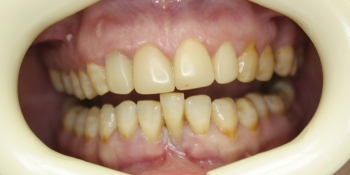 Устранение подвижности зуба - фото №1