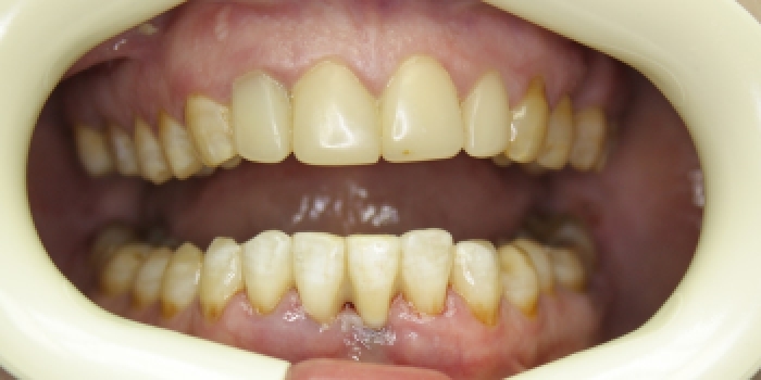 Устранение подвижности зуба - фото №2