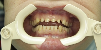 Реставрация зубов с применением композитных виниров - фото №1