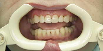 Реставрация зубов с применением композитных виниров - фото №2