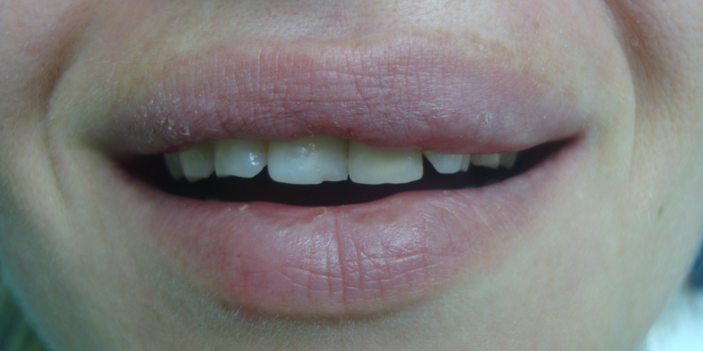 Преображение цвета и формы передних зубов (верхний ряд) - фото №1