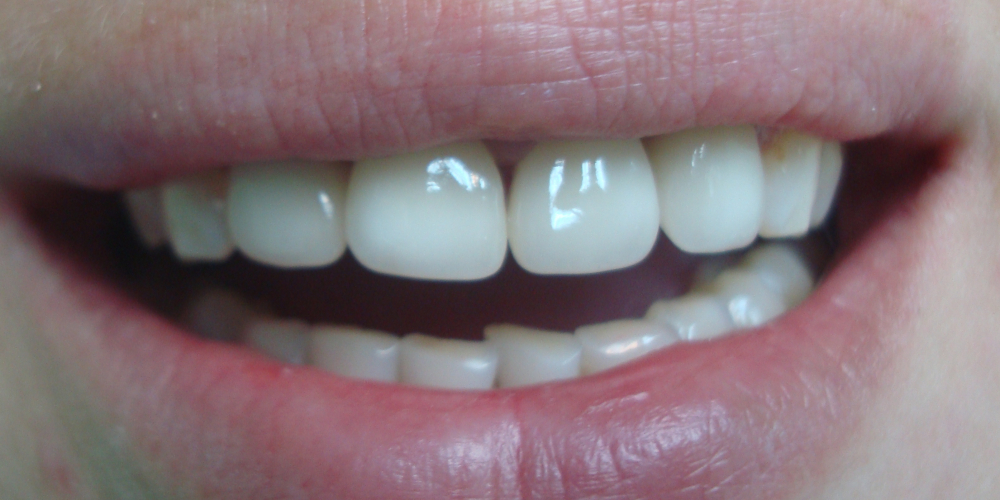 Отбеливание зубов иркутск. Нет второго зуба на Верхнем ряду фото.