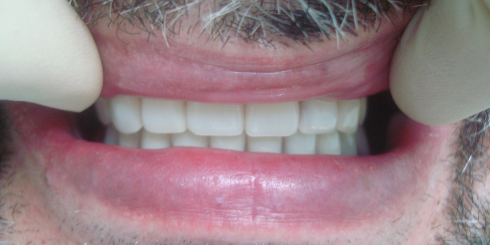 Восстановление зубов на верхней и нижней челюсти (полная адентия - отсутвуют все зубы) - фото №4