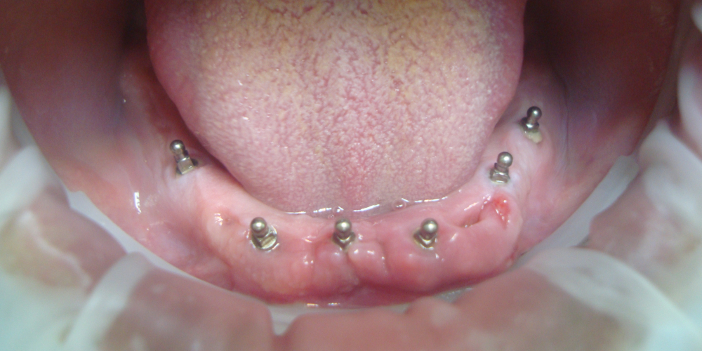 Восстановление зубов на верхней и нижней челюсти (полная адентия - отсутвуют все зубы) - фото №3