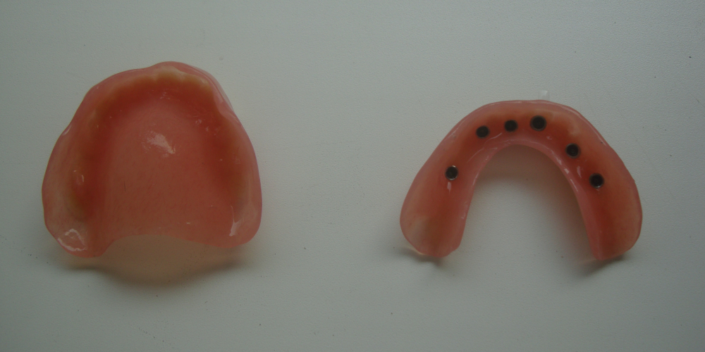 Восстановление зубов на верхней и нижней челюсти (полная адентия - отсутвуют все зубы) - фото №2