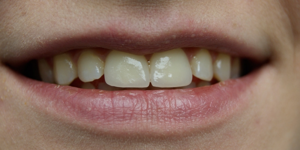 Керамические виниры с закрытием щели между зубами (диастема) - фото №2