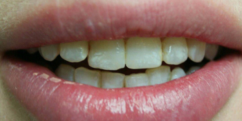 Преображение цвета и формы передних зубов (верхний и нижний ряд) - фото №1