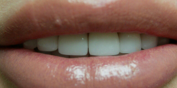 Преображение цвета и формы передних зубов (верхний и нижний ряд) - фото №2
