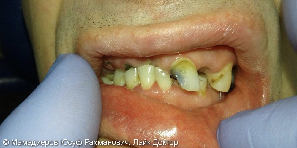 Протезирование металлокерамическими коронками 20-ти зубов, до и после - фото №1