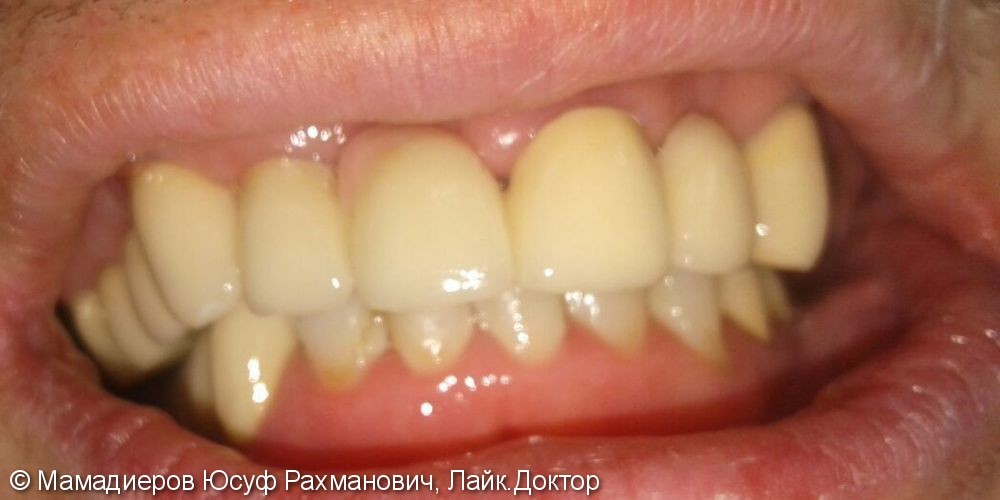 Протезирование металлокерамическими коронками 20-ти зубов, до и после - фото №2