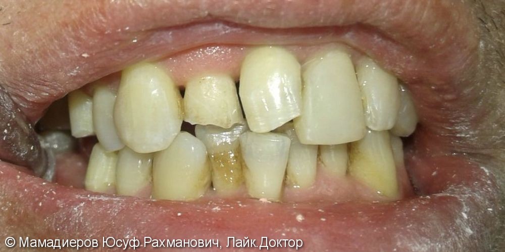 Безметалловые керамические коронки на передние зубы 11, 12, до и после - фото №1