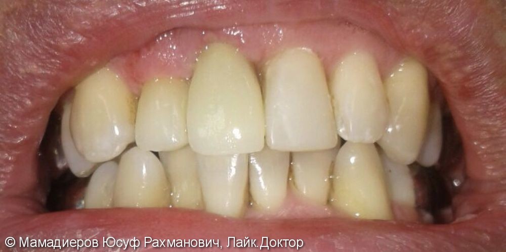 Безметалловые керамические коронки на передние зубы 11, 12, до и после - фото №2