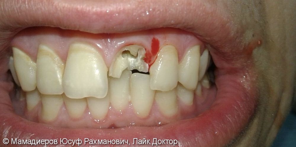 Восстановление разрушенной коронковой части зуба в одно посещение - фото №1