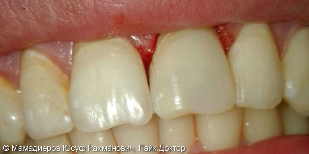 Восстановление разрушенной коронковой части зуба в одно посещение - фото №2