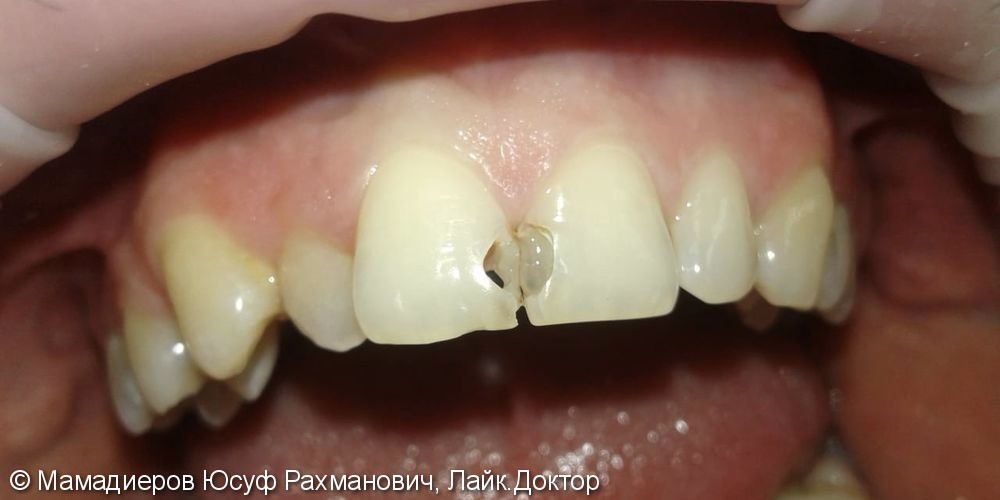 Лечение вторичного кариеса передних зубов 11,21, до и после - фото №1