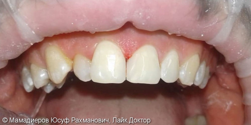 Лечение вторичного кариеса передних зубов 11,21, до и после - фото №2