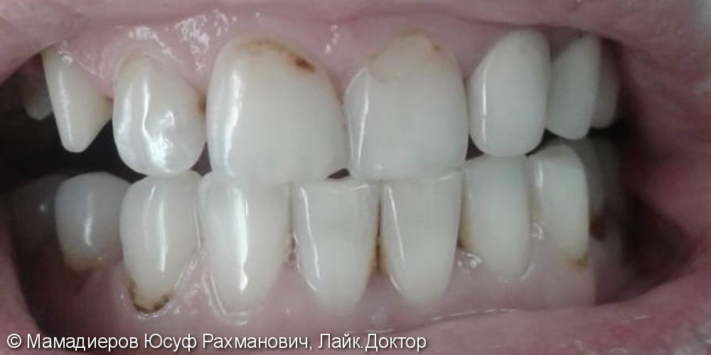 Лечение пришеечного кариеса 3-х зубов, реставрация, мк коронки - фото №1