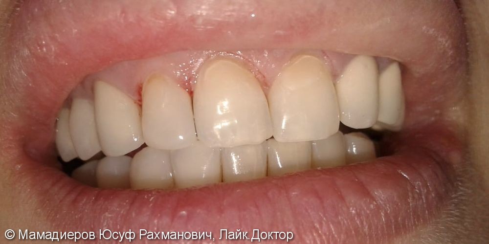 Лечение пришеечного кариеса 3-х зубов, реставрация, мк коронки - фото №2