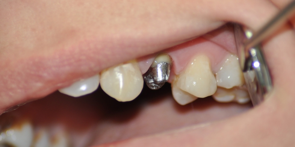 Зуб восстановлен металлической культевой вкладки и м/к коронки - фото №1