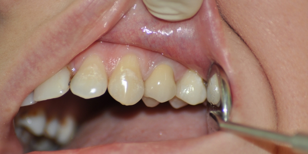 Зуб восстановлен металлической культевой вкладки и м/к коронки - фото №2