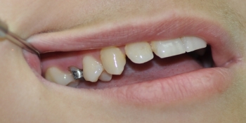 Восстановление коронки жевательного зуба - фото №1