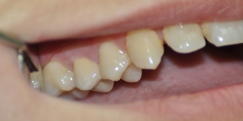 Восстановление коронки жевательного зуба - фото №2