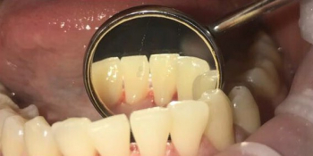 Результат проф чистки зубов - фото №2